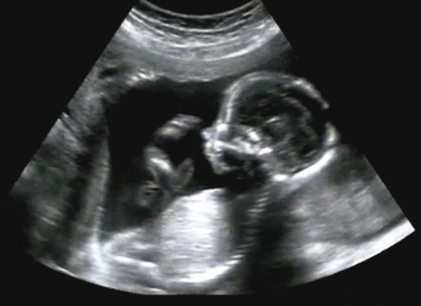 3D and 4D Sonography